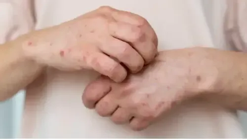 Chickenpox: Diagnosis, Stages & Treatment